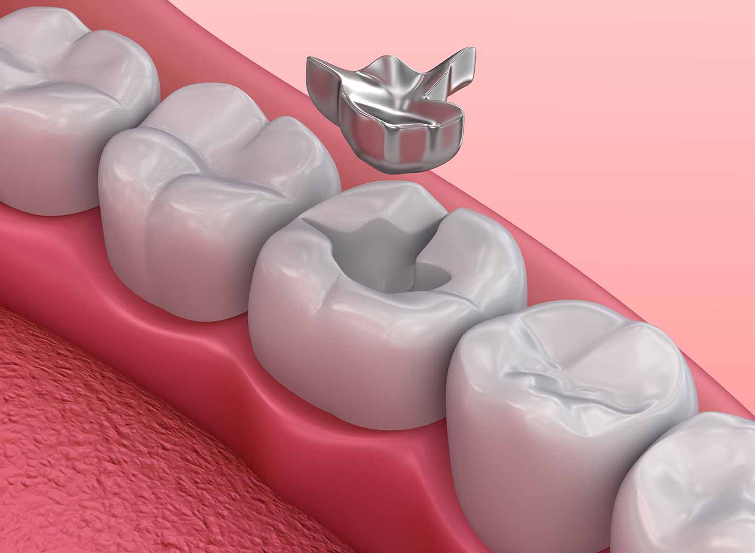 Rejeneratif Endodontik Tedavi